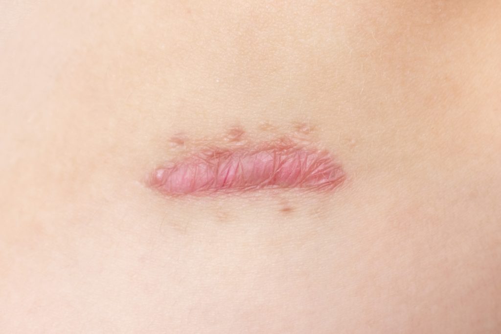 Close up of cyanotic keloid scar